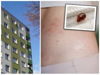 Ľudia v Bratislave si počítajú štípance: Sídliskom sa šíri nebezpečný PARAZIT, môže dôjsť k zamoreniu