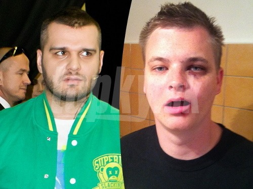 Patrik Rytmus Vrbovský (vľavo) vraj zaútočil na moderátora Kazmu. Ten nám poslal do redakcie záber, na ktorom má doráňanú tvár (vpravo).