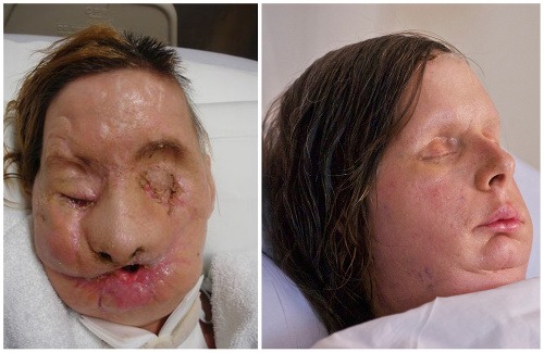 Carla pred a po transplantácii