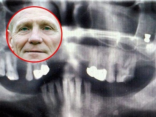 Röntgenový snímok odhalil náboj v Tommyho zube