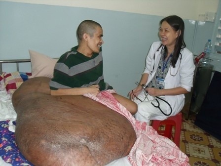 Nguyenov nádor je naozaj obrovský