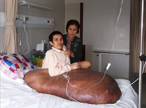 Nguyen Duy Hai s 90-kilovým nádorom