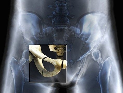 Röntgenový snímok zlomenej lonovej kosti