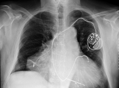 Kardiostimulátor prepája obe srdcia