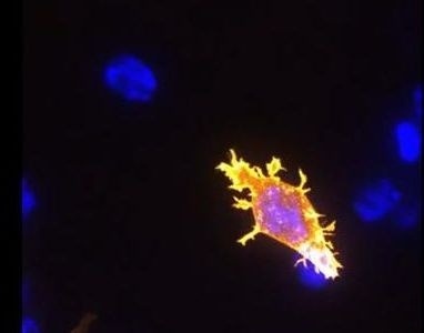 T-lymfocyt bojuje s rakovinou