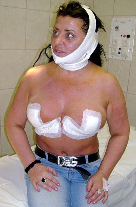 Joanne krátko po operácii