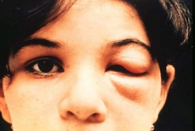 Dievča trpiace Chagasovou chorobou