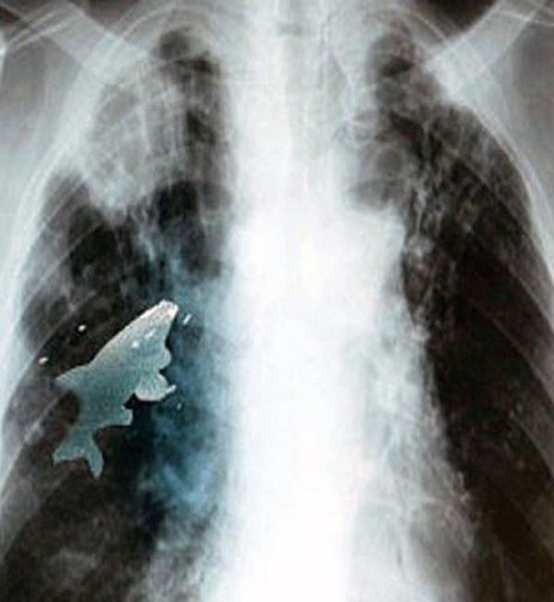 Röntgenový snímok chlapcovho hrudníka