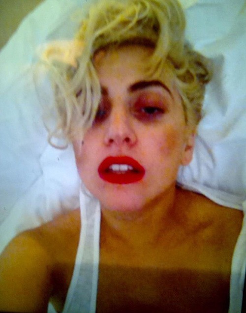 Lady Gaga má po desivom úraze otras mozgu a na tvári monokle.