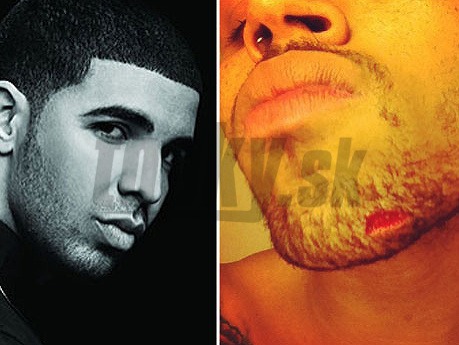 Drake a rana, ktorú utŕžil Chris Brown v bare.