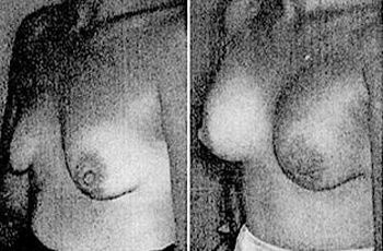 Prvé silikónové prsia na svete