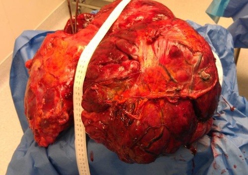 Obrovský nádor vážil až 23 kíl
