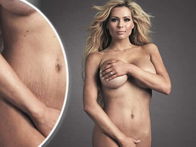 Nicola McLean úplne nahá a bez retuše vystavila svoje zhyzdené brucho.