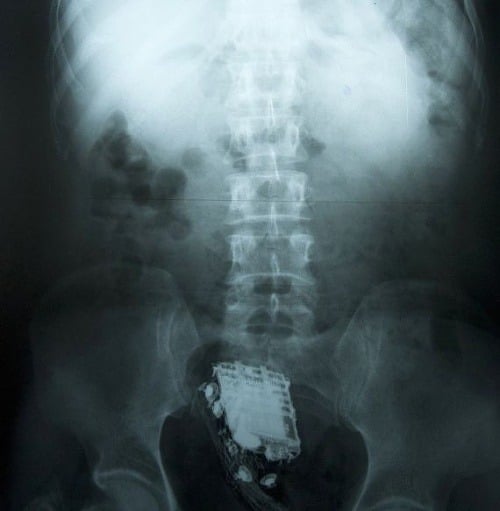 Röntgenová snímka väzňovho zadku