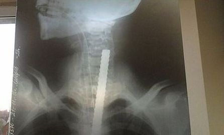 Röntgenová snímka Andrejovho prepichnutého tela