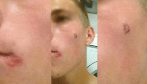 Nezistený druh infekcie