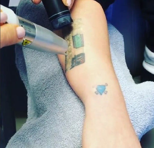 Kelly Osbourne si nechala odstrániť tetovanie