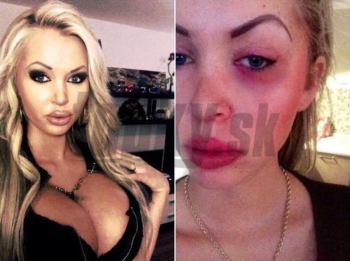 Sexica Michaela Gašparovičová na uplynulý štvrtok tak skoro nezabudne - zbil ju opitý útočník. 