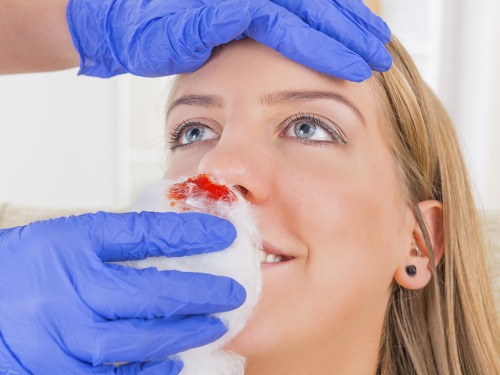 Ako účinne zastaviť krvácanie z nosa?