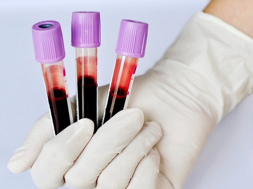 Výskumy dokazujú, že aj krvná skupina hrá úlohu v tom, či budeme trpieť nejakou chorobou alebo nie