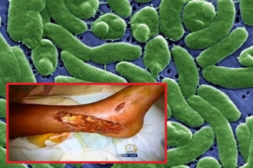 Baktéria rozožiera ľudské tkanivo
