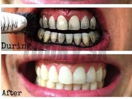 Používať ČIERNE UHLIE je ako šúchať si piesok po zuboch