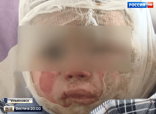 Dvojročný chlapec utrpel rozsiahle popáleniny