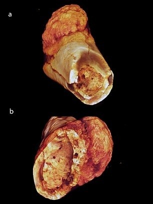 Rakovina na prste prehistorického človeka