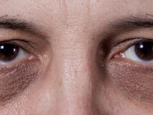 Trápia vás kruhy pod očami, pričom ste spali dlho a dobre? Toto sú možné príčiny! 