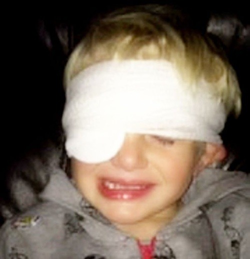 Jay bol päť dní slepý na jedno oko