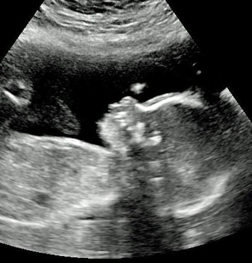 Oliverove háro vidno na ultrazvuku