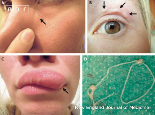 Selfie fotky Rusky, ktoré zachytávajú pohyb červa po jej tvári. 