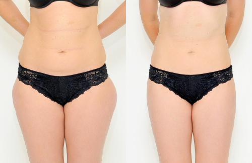 Klientka Lenka sa tukových