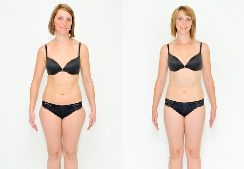 Klientka Lenka liposukciou vyriešila