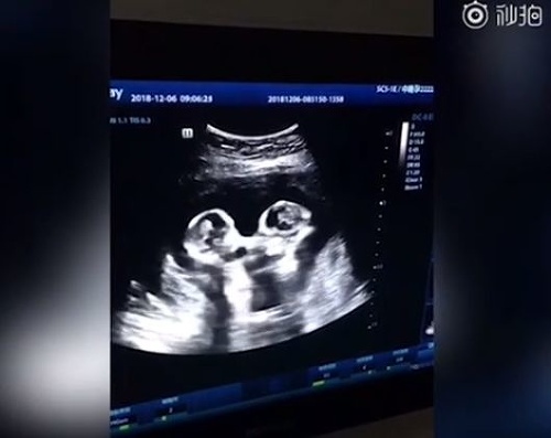 VIDEO Otec nakrúcal ultrazvuk