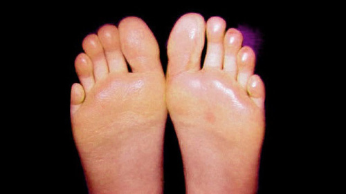 Nežiaduce účinky pri potení.