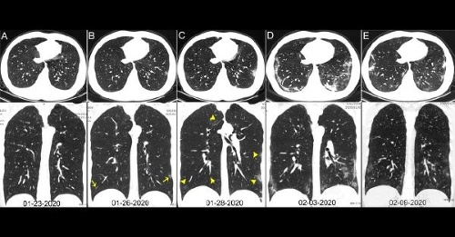 CT snímky 29-ročného muža nakazeného vírusom SARS-coV-2. Žlté šípky ukazujú na mliečny zákal v bilaterálnych dolných pľúcnych lalokoch