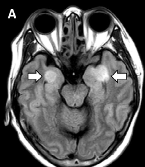 MRI snímka ukazuje abnormality v mozgových lalokoch a talame