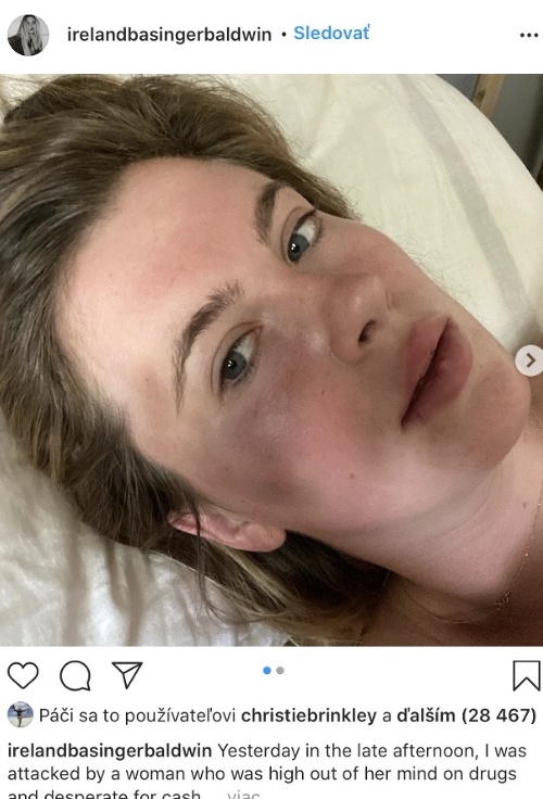 Ireland Baldwin zverejnila fotky po útoku, pri ktorom ju okradli.