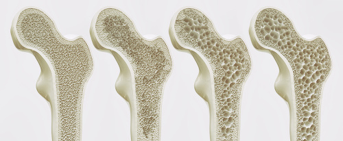 Osteoporóza a jej štádiá