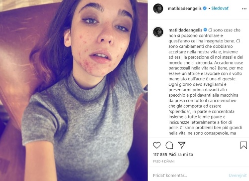 Matilda De Angelis zverejnila fotku, na ktorej svetu ukázala, že má problematickú pleť.
