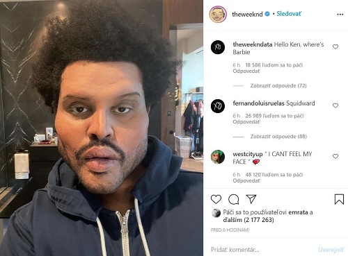 Spevák The Weeknd opäť šokoval fanúšikov zmenenou tvárou. 
