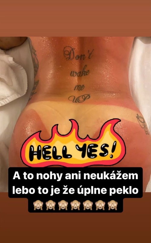 Kráľovnú slovenského Instagramu nezachránil ani vysoký ochranný faktor. 