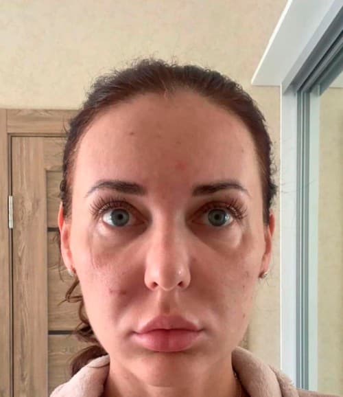 Svetlana (37) podstúpila kozmetický