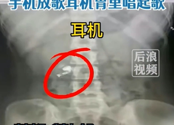 Slúchadlo v bruchu sa objavilo na RTG snímke