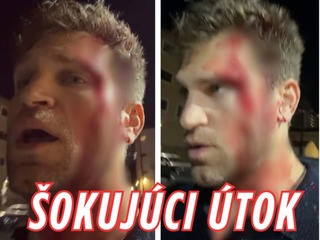 Známeho herca prepadli ozbrojení lupiči: Kvôli hodinkám ho takmer zabili!