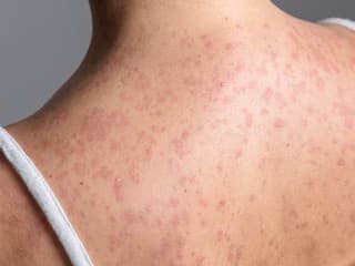 Osýpky v Európe silnejú: Jeden chorý môže nakaziť až 18 ľudí, ako sa chrániť?