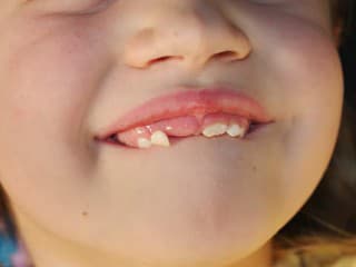 Zlé zuby nie sú genetika: Čo o kazoch a ústnej hygiene prezrádza zubárka!