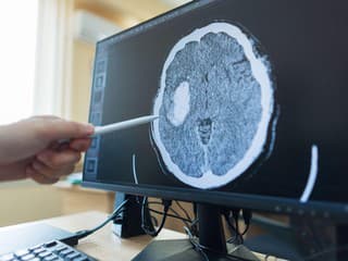 Revolúcia v liečbe rakoviny: Nový test skrátil diagnostiku nádorov mozgu z týždňov na hodiny