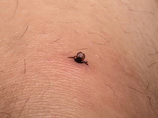 Zostal vám po vybratí kúsok kliešťa v koži? Lekárka radí, čo s ním určite nerobiť